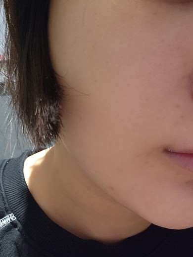 after photo: 앞광대필러