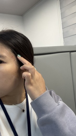 before photo: 아쿠아필링