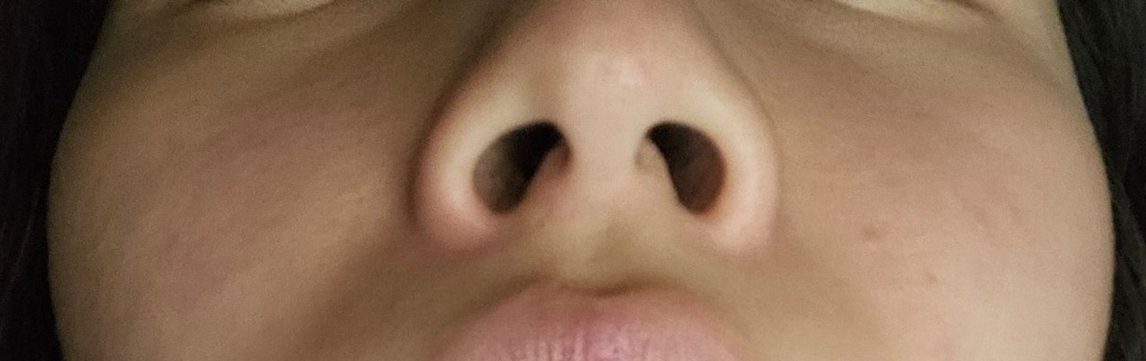 before photo: 콧볼축소