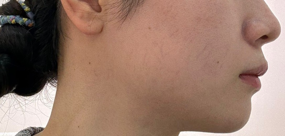 before photo: チタニウムリフト
