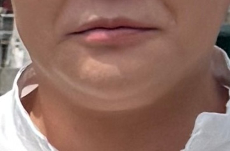 before photo: 이중턱지방흡입, 이중턱근육묶기