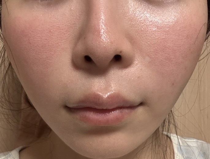 before photo: IPL(光/フォト治療)