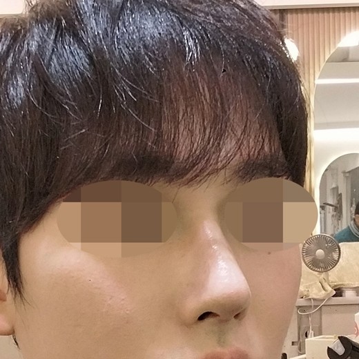 after photo: 콧대(자가조직), 코끝(자가연골)