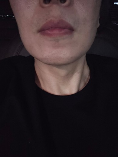 after photo: 아쿠아필링, 수염제모