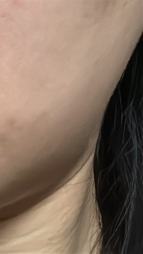 after photo: 脂肪溶解注射(顔)