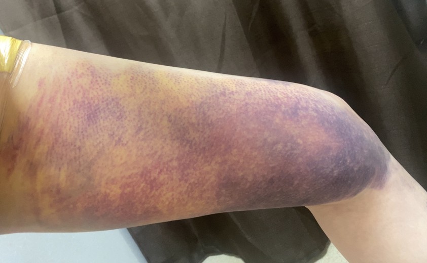 after photo: 豊胸(脂肪注入)