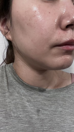 after photo: 診断・検査, ジュベルック(Juvelook)