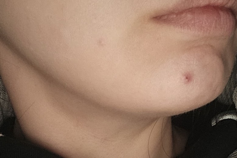 before photo: 침샘보톡스