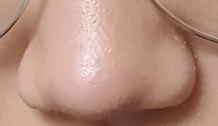 after photo: 콧볼축소