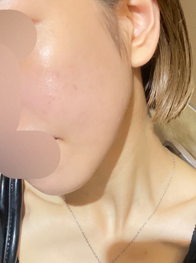 after photo: IPL(光/フォト治療)
