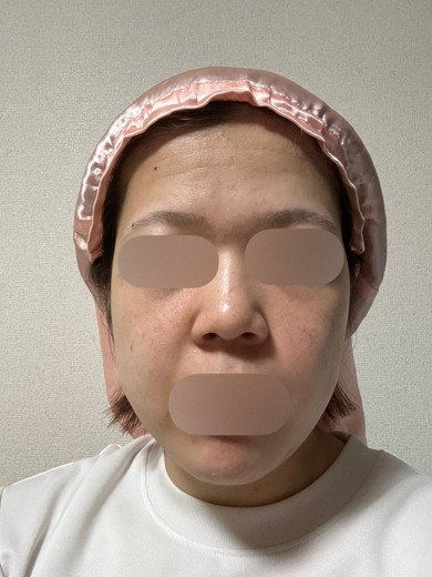 after photo: フラクショナルレーザー, レーザートーニング, ほくろ除去(レーザー)
