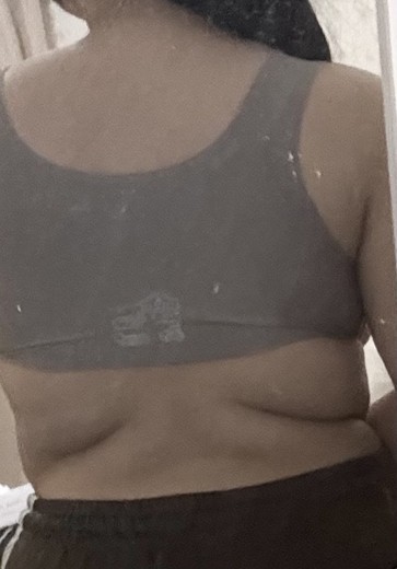 after photo: 脂肪冷却(腕)