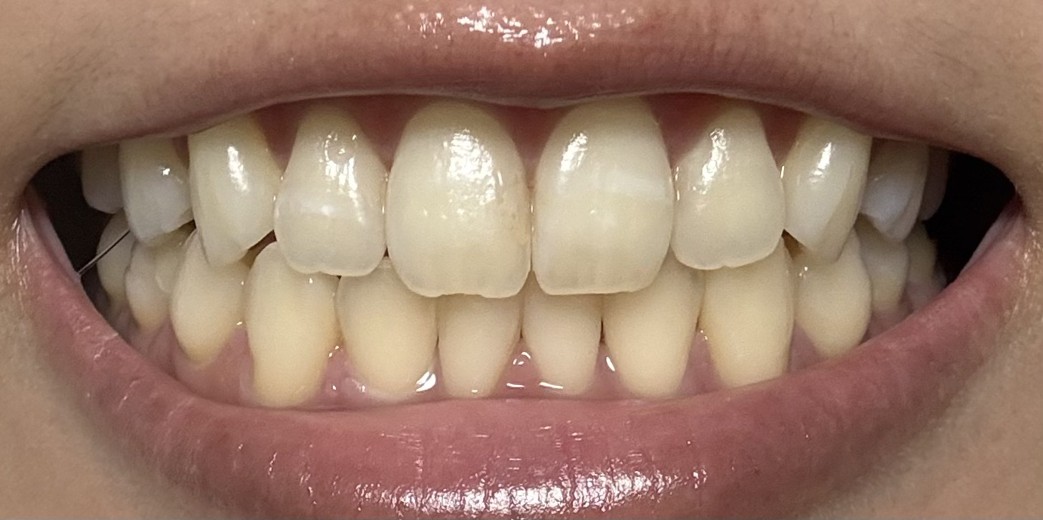 before photo: ホワイトニング