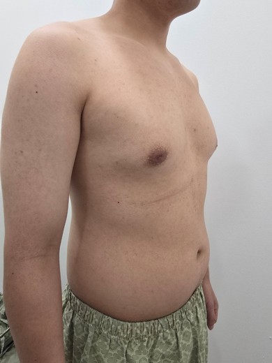 before photo: 여유증수술