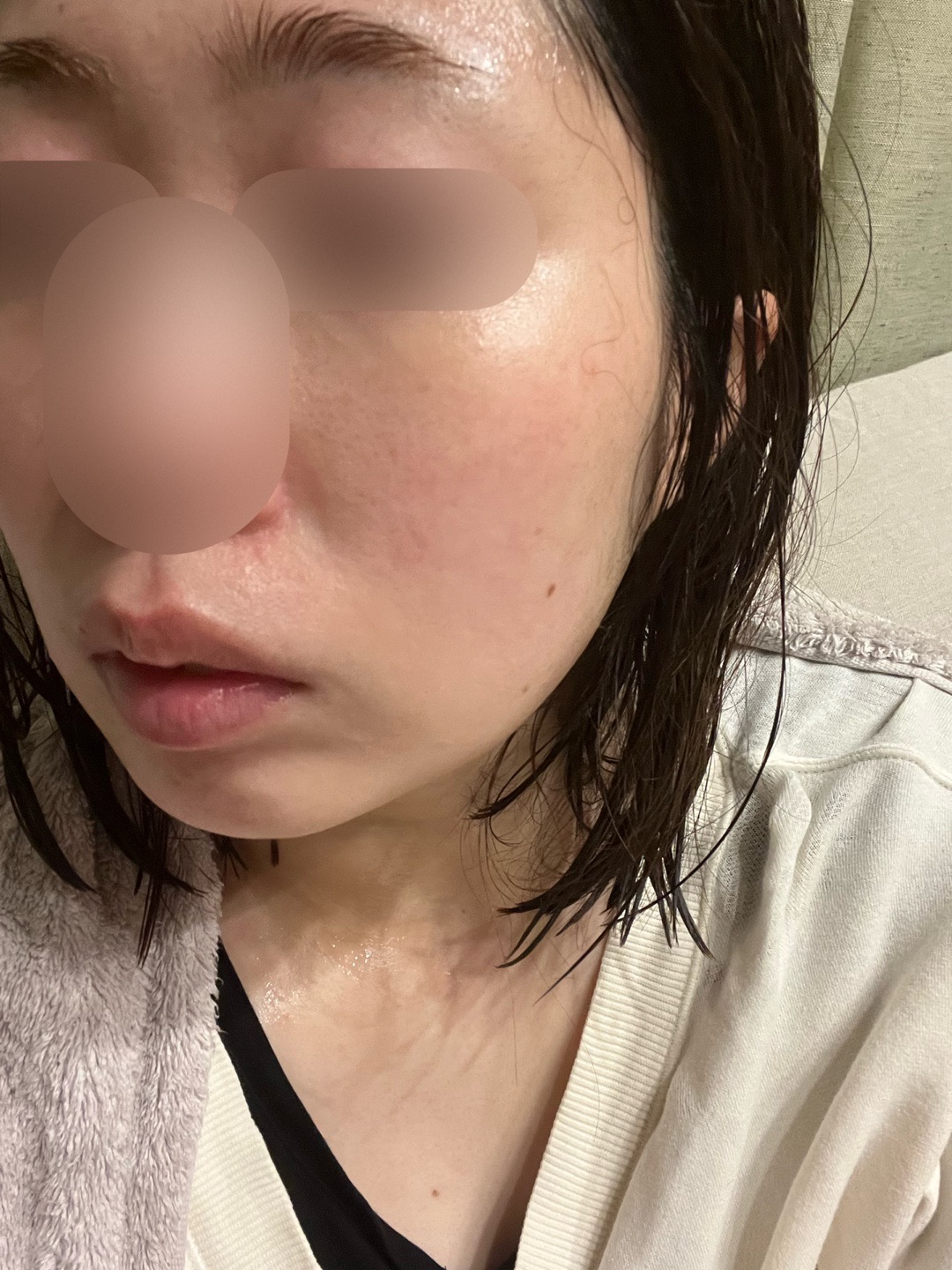 ピーリング　エレクトロポレーション マッサージピール、エレクトロポレーション、ケミカルピーリング