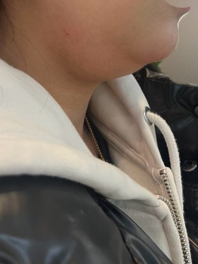 after photo: 脂肪溶解注射(顔)