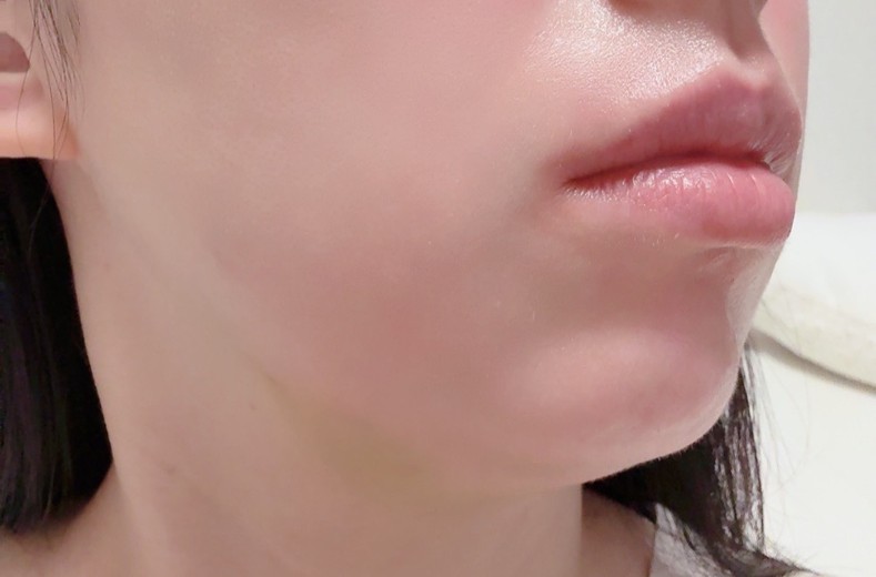after photo: 脂肪溶解注射(顔)