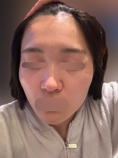 after photo: IPL(光/フォト治療), ピーリング, エレクトロポレーション