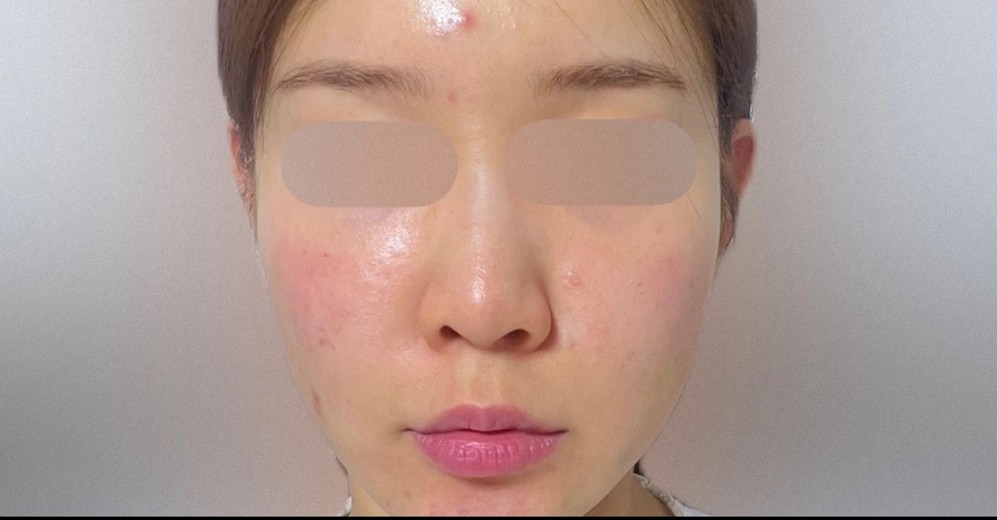 before photo: PRP피부재생술