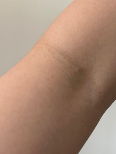 after photo: 白玉注射・点滴