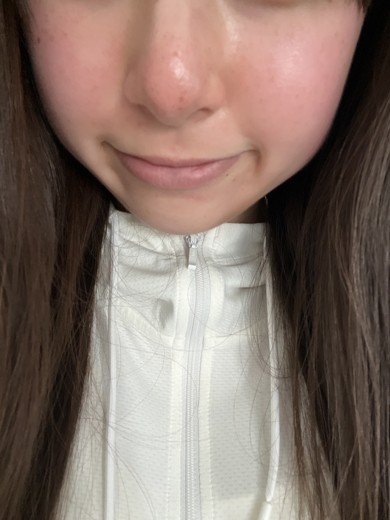after photo: ダーマペン