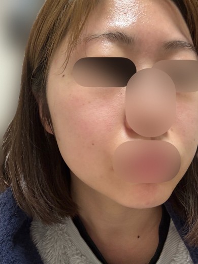 before photo: 白玉注射・点滴