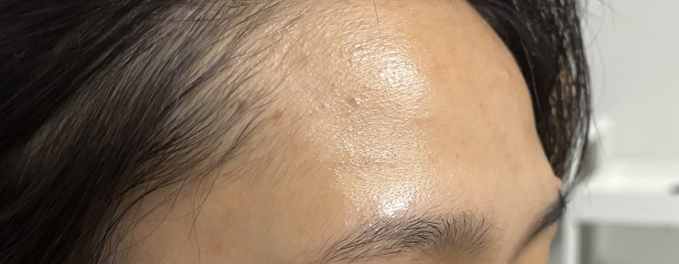 before photo: 이마필러, 관자놀이필러