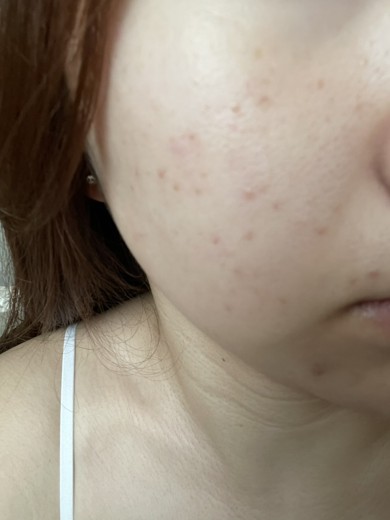 after photo: IPL(光/フォト治療), 診断・検査