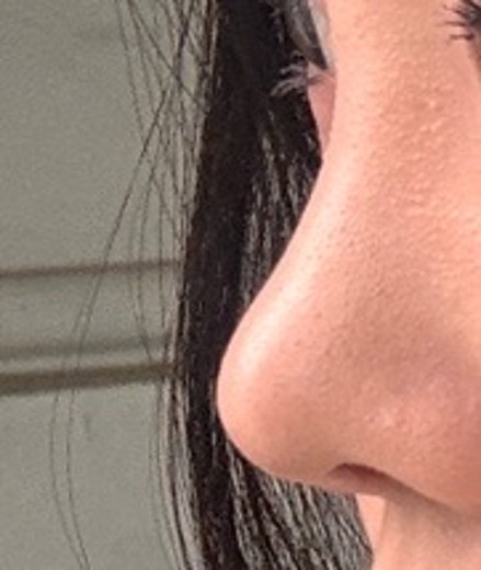 after photo: 콧대(보형물), 코끝(자가연골)