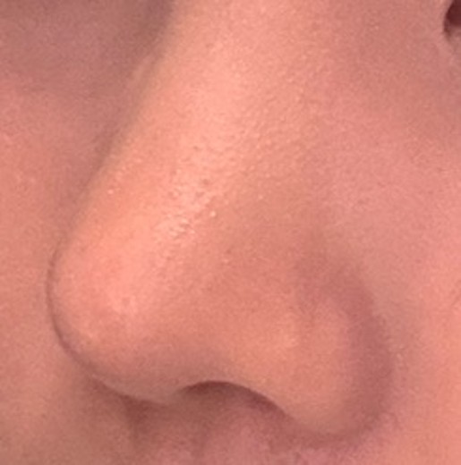 after photo: 콧대(보형물), 코끝(자가연골)