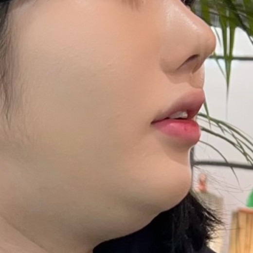 before photo: 이중턱지방흡입, 이중턱근육묶기