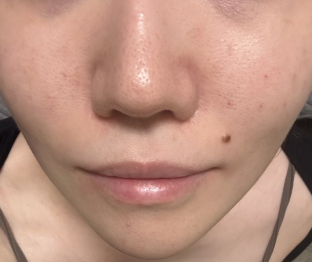 after photo: ジュベルック(Juvelook)
