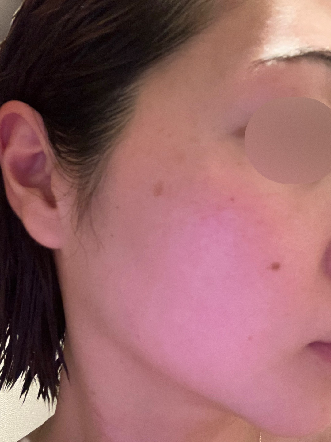 GSD フォトフェイシャル GSD フォトフェイシャル フォトフェイシャル