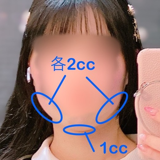 before photo: 脂肪溶解注射(顔)