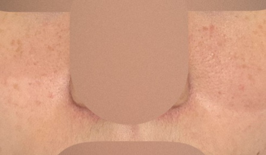 after photo: 아쿠아필링