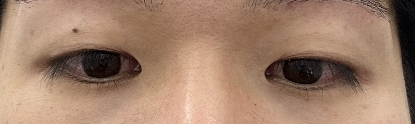 after photo: 眼瞼下垂(目つき矯正)