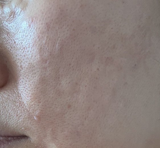 after photo: 리쥬란힐러