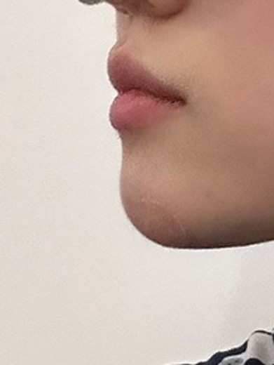 before photo: 필러제거주사