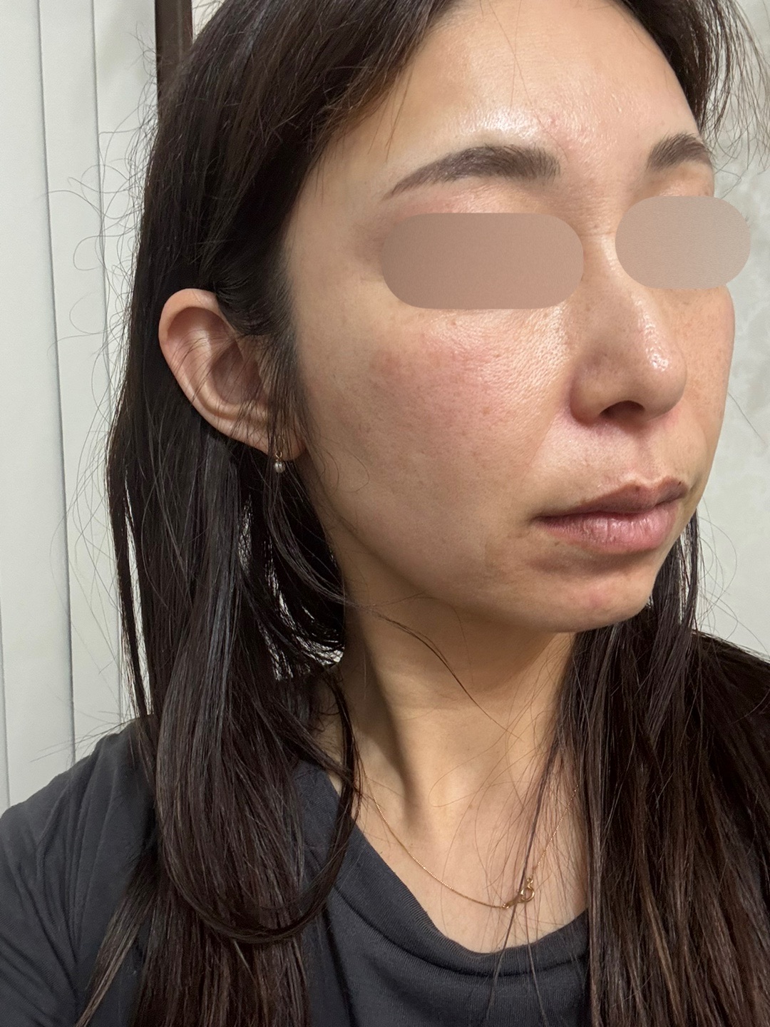 何度でも可】全顔シミ取り放題＋美顔レーザートーニング | ZX-CLINIC