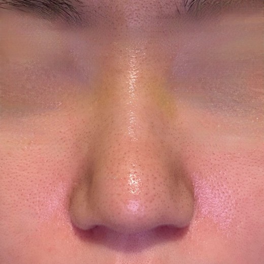 after photo: 콧볼축소, 복코교정(수술)