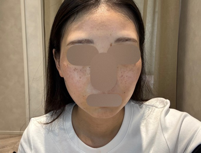 after photo: ルメッカ