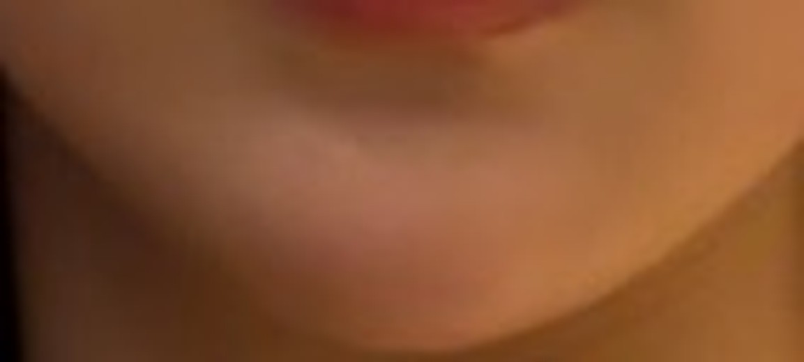 after photo: 윤곽주사