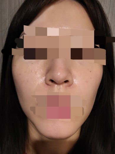before photo: ハイドラフェイシャル, 診断・検査