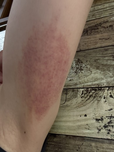 after photo: 脂肪冷却(腕)