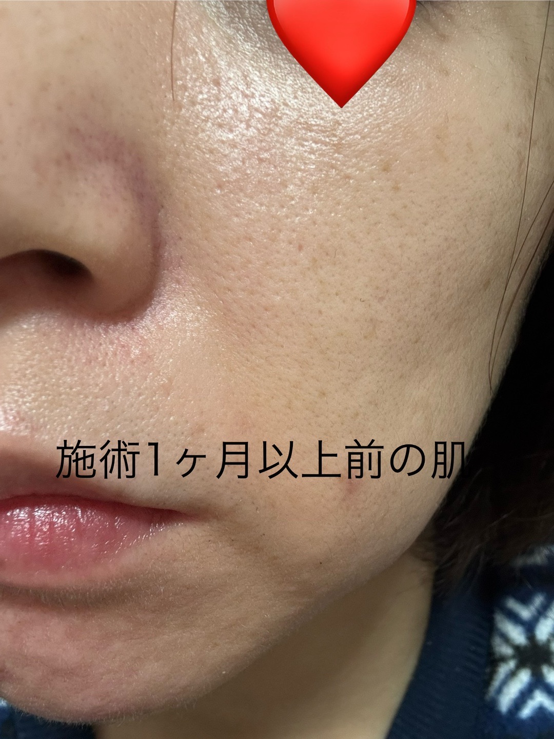 リジュラン】美白もできるダーマペン用薬剤「TONE-UP BOOSTER
