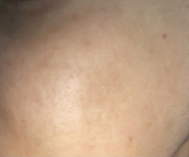 after photo: 리쥬란힐러, 스킨보톡스