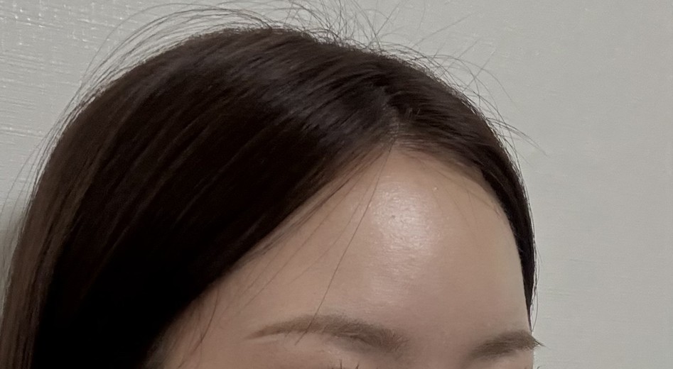 after photo: 이마필러