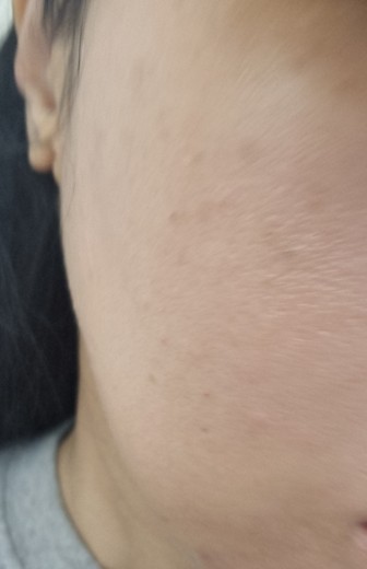 after photo: 엘라비에리투오