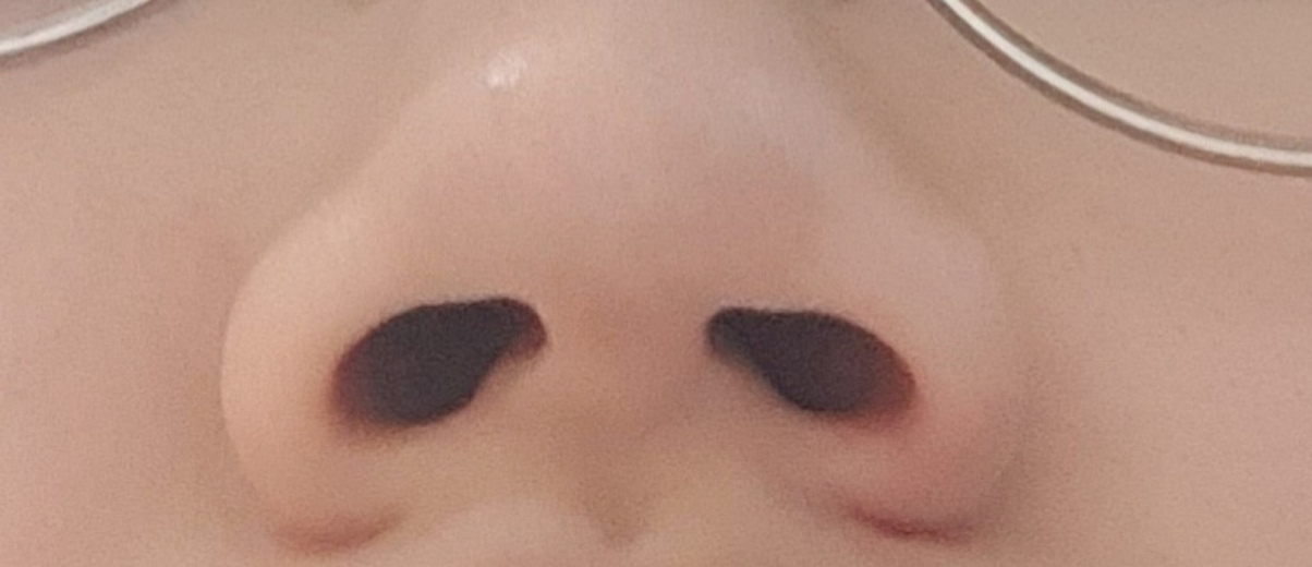 before photo: 콧볼축소