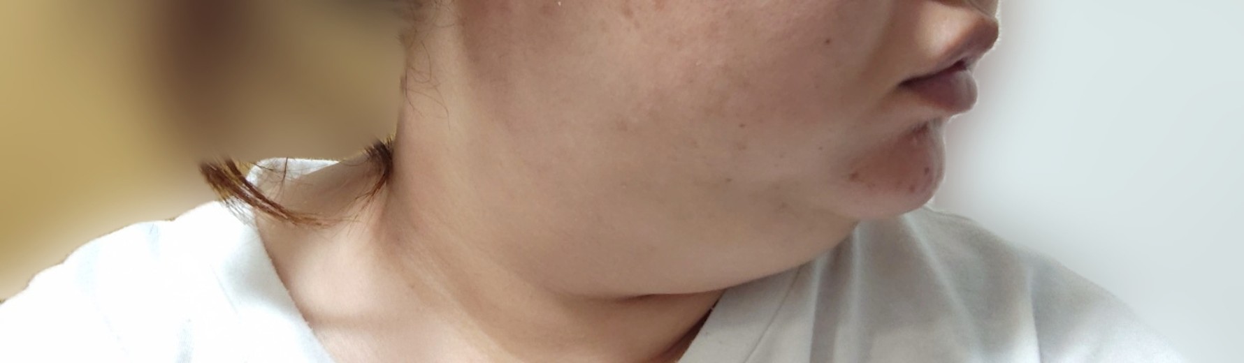 after photo: 脂肪溶解注射(顔)
